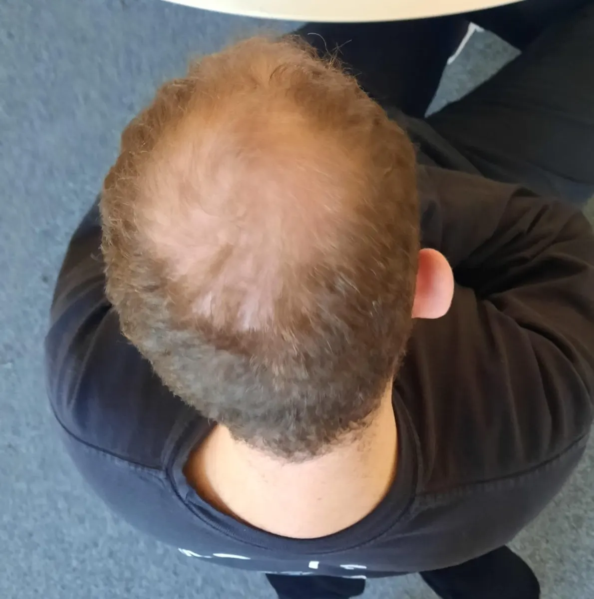 גבר במבט מלמעלה עם דילול בקודקוד ובמרכז הראש, בשלב מוקדם של התקרחות תורשתית