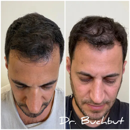לפני ואחרי טיפול בדילול שיער בחלק הקדמי של הראש, גבר (125 מתוך 159)