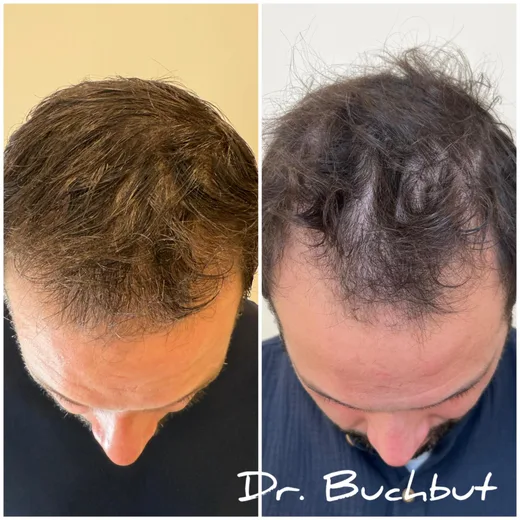 לפני ואחרי טיפול בדילול שיער בחלק הקדמי של הראש, גבר (44 מתוך 159)
