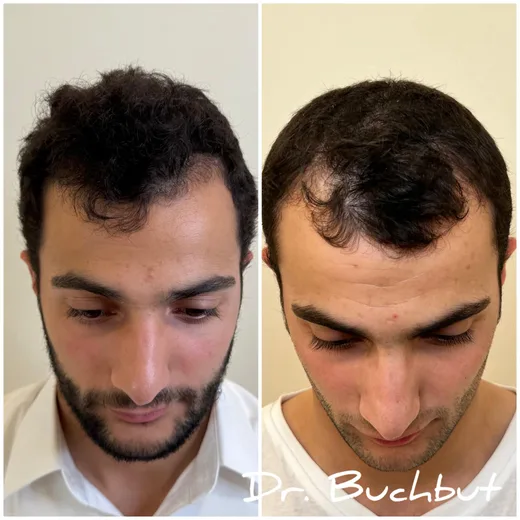 לפני ואחרי טיפול בדילול שיער בחלק הקדמי של הראש, גבר (131 מתוך 159)