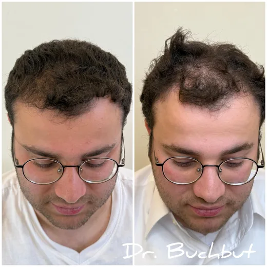 לפני ואחרי טיפול בדילול שיער בחלק הקדמי של הראש, גבר (138 מתוך 159)