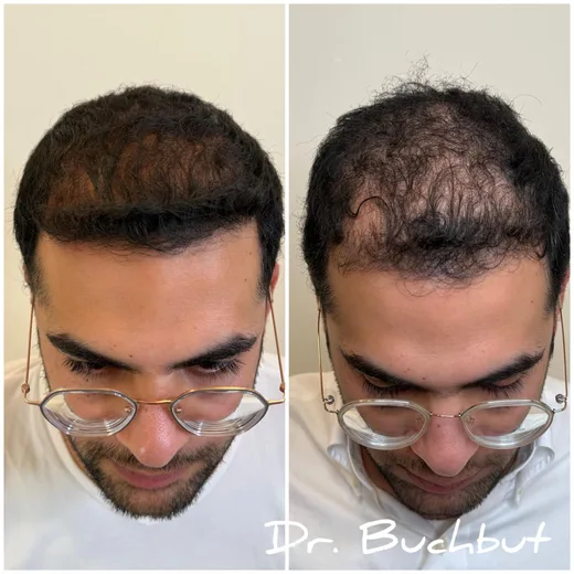 לפני ואחרי טיפול בדילול שיער בחלק הקדמי של הראש, גבר (139 מתוך 159)