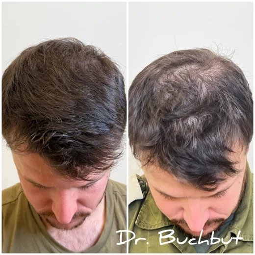 לפני ואחרי טיפול בדילול שיער בחלק הקדמי של הראש, גבר (105 מתוך 159)