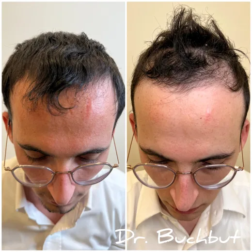 לפני ואחרי טיפול בדילול שיער בחלק הקדמי של הראש, גבר (108 מתוך 159)