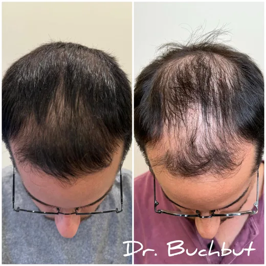 לפני ואחרי טיפול בדילול שיער בחלק הקדמי ובכתר של הראש, גבר (15 מתוך 25)