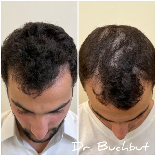 לפני ואחרי טיפול בדילול שיער בחלק הקדמי ובכתר של הראש, גבר (19 מתוך 25)