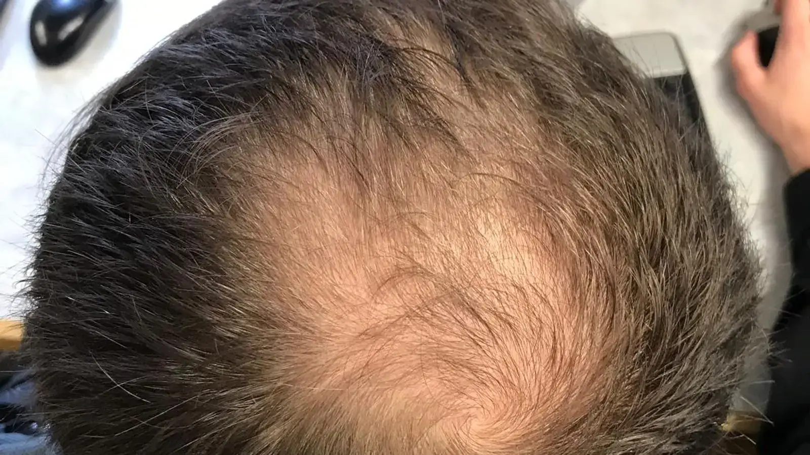 גבר במבט מלמעלה עם דילול בולט בקודקוד, המראה שמעורר את הלחץ הרגשי סביב נשירת שיער