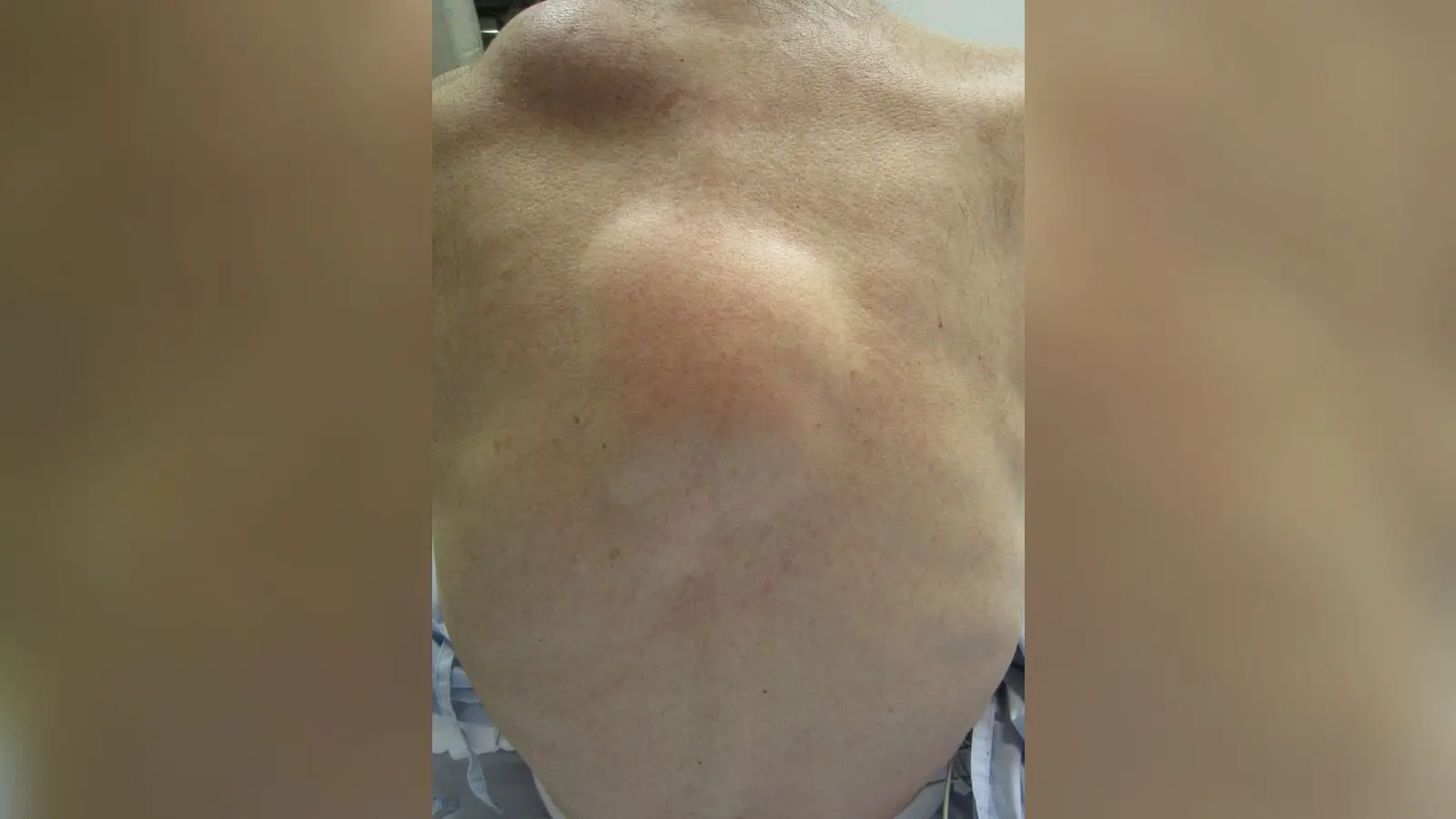 ליפומה גדולה בגב: בליטה רכה ועגולה מתחת לעור שנראה רגיל