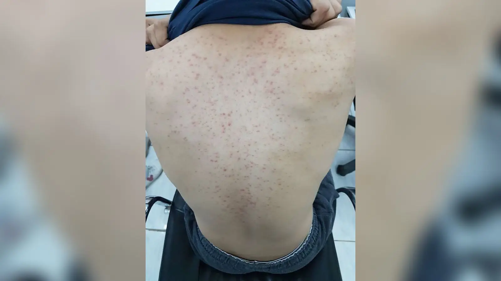 גב עם פצעונים אדומים אחידים סביב הזקיקים אצל בחור צעיר עם פוליקוליטיס משמרי מלסזיה